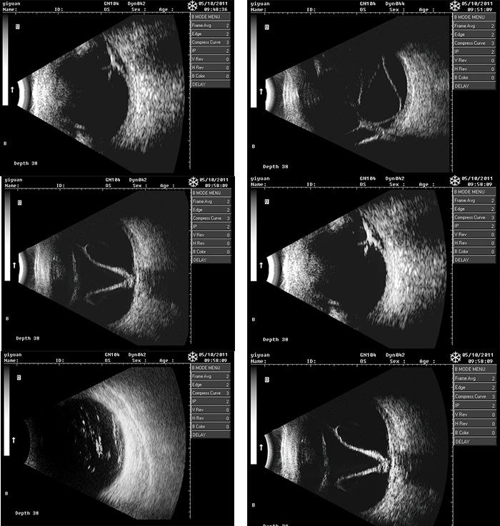 CAS-2000d China Ophthalmic Equipment Ophthalmology Ultrasound Ab Scanner a B Scan with Built-in Computer